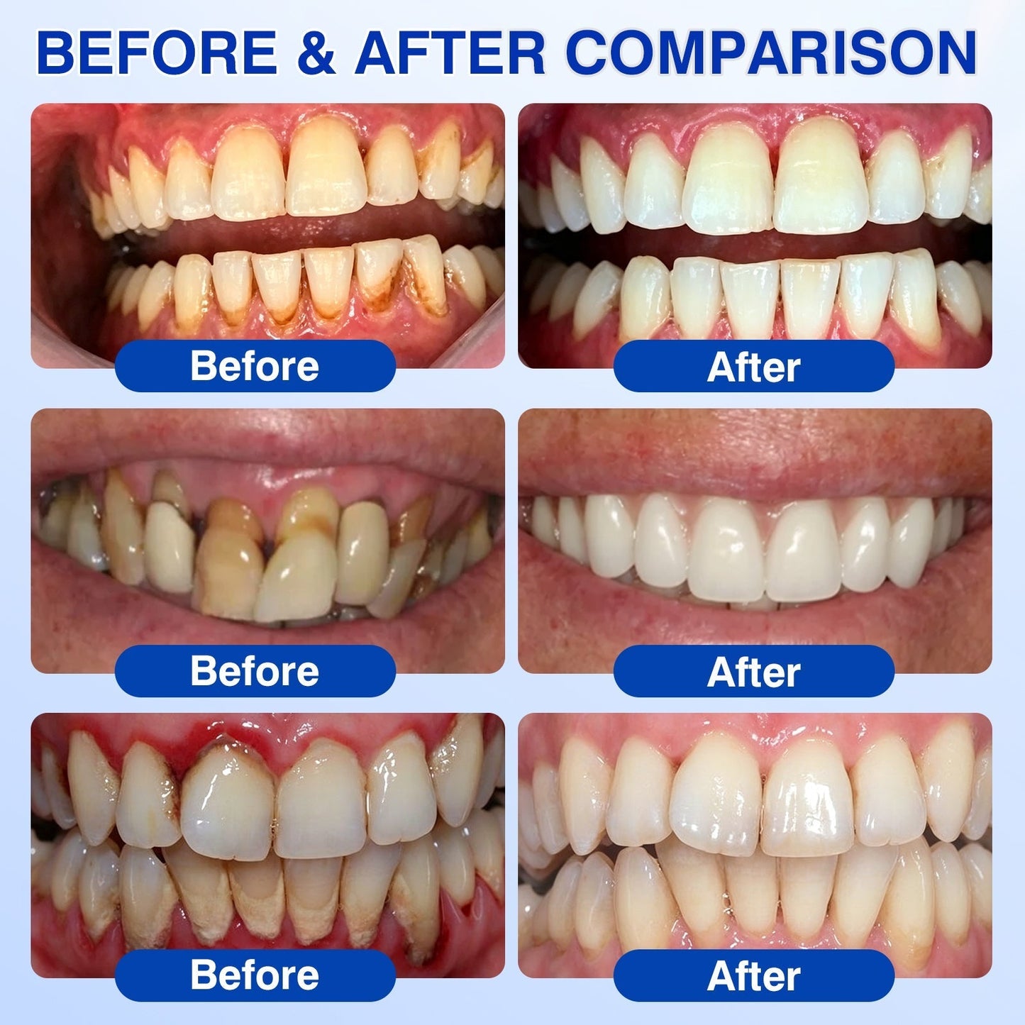 👨‍⚕️🦷🛡️TopSpire® GumRevive Periodontal Repair Gel
