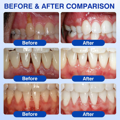 👨‍⚕️🦷🛡️TopSpire® GumRevive Periodontal Repair Gel