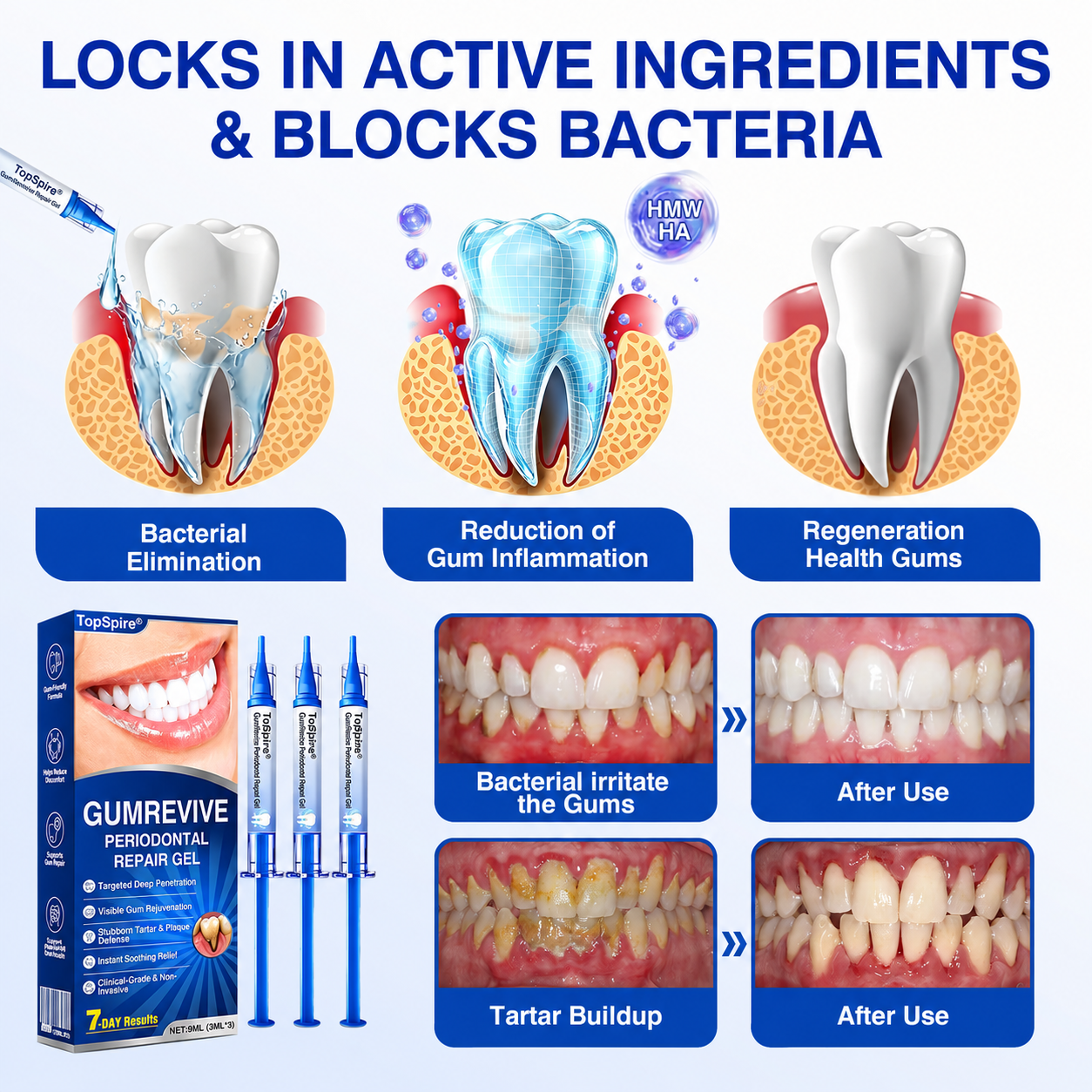 👨‍⚕️🦷🛡️TopSpire® GumRevive Periodontal Repair Gel